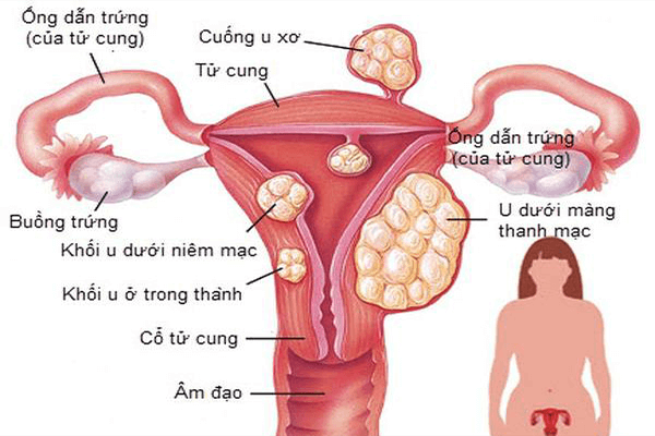 Cần biết - Tổng hợp các bệnh phụ khoa phổ biến và cách điều trị hiệu quả (Hình 3).