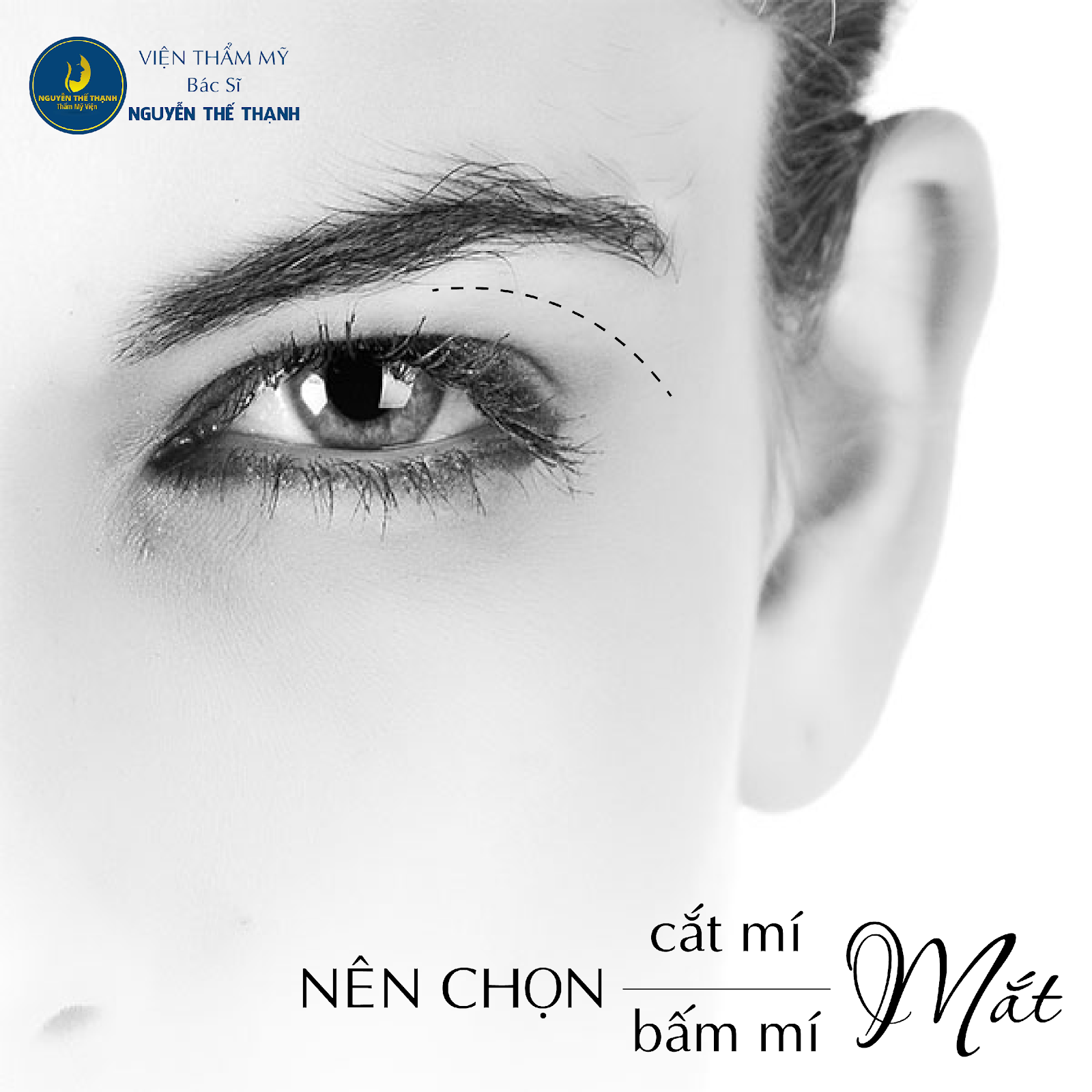 Cần biết - Nên chọn cắt mí mắt hay bấm mí mắt?