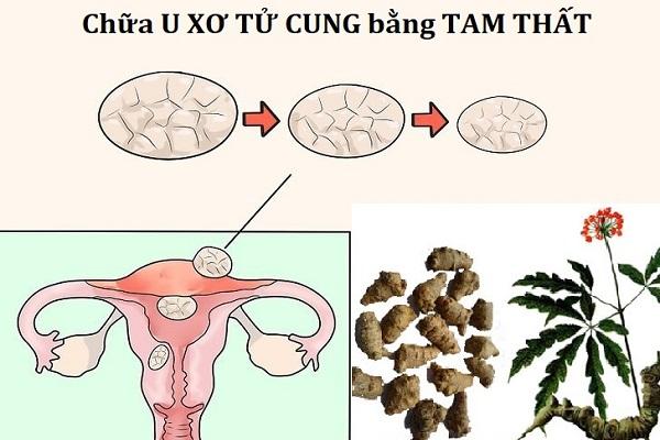 Cần biết - Chữa u xơ tử cung bằng tam thất có hiệu quả không?