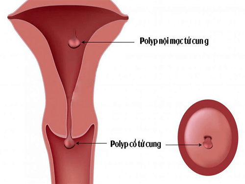 Cần biết - Mẹ bầu bị Polyp tử cung khi mang thai phải làm sao? (Hình 2).