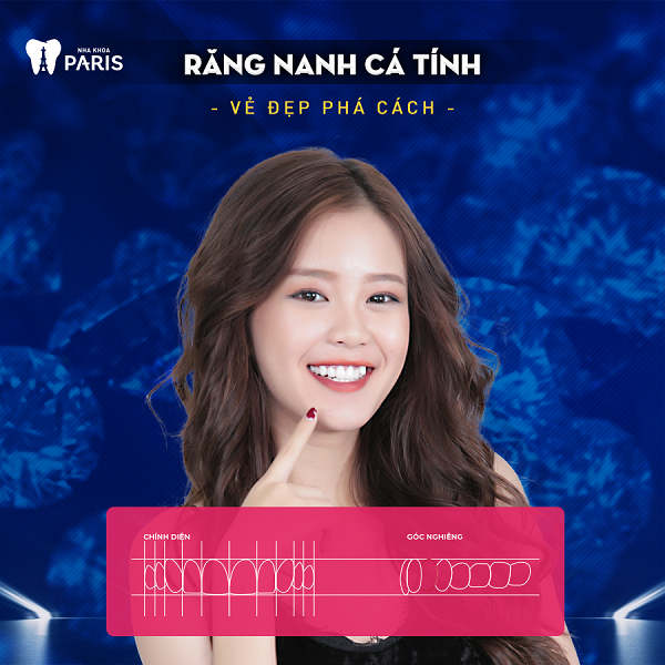 Cần biết - 5 quy tắc vàng để có nụ cười đẹp “hút hồn” nhờ phương pháp bọc răng sứ (Hình 3).