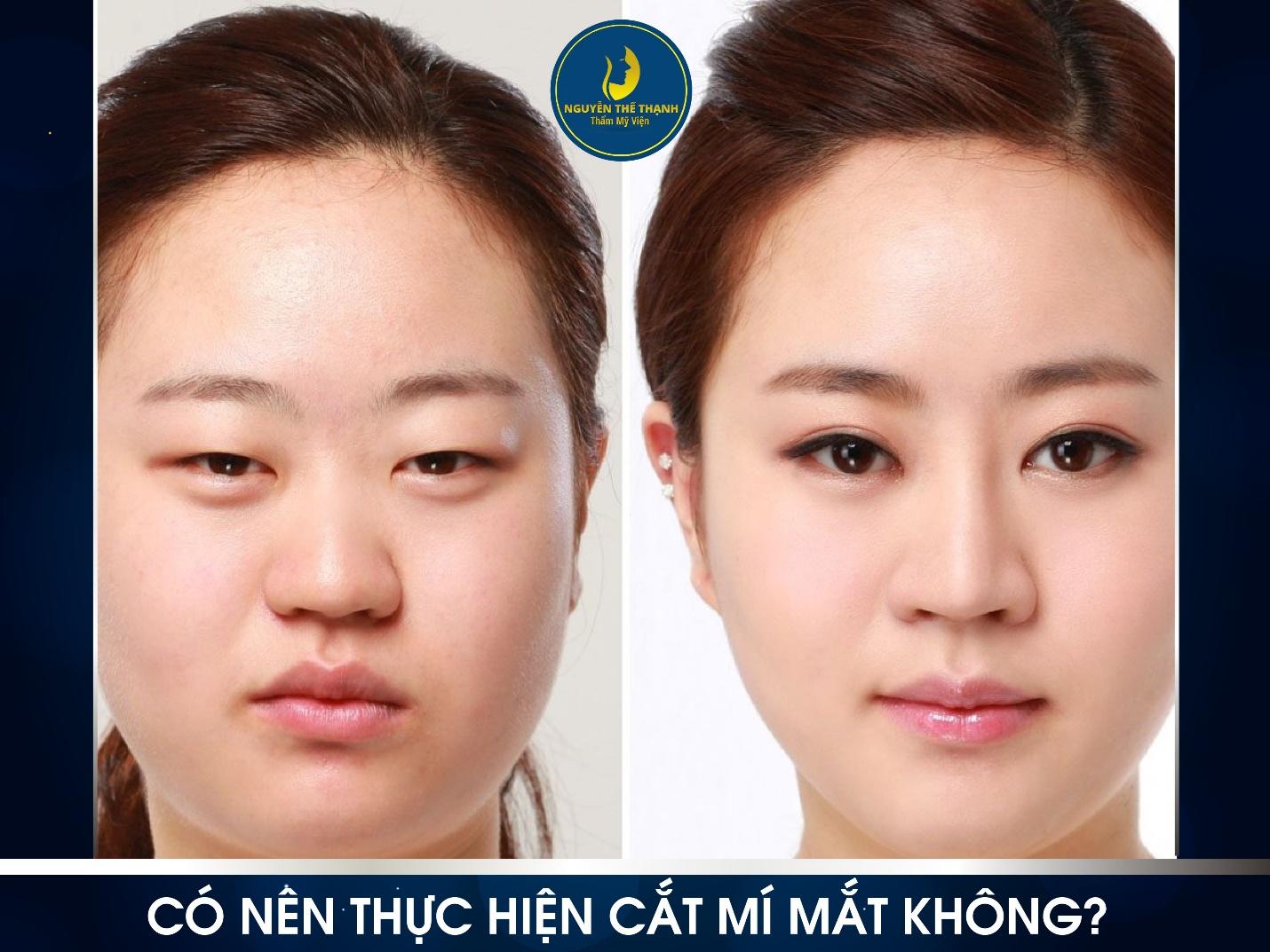 Cần biết - Có nên thực hiện cắt mí mắt không? (Hình 2).