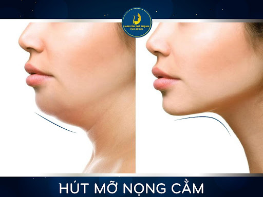 Cần biết - Hút mỡ nọng cằm - Xóa tan mỡ thừa cho mặt thon gọn (Hình 2).