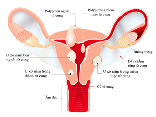 Cần biết - 8 triệu chứng u xơ tử cung rõ ràng nhất chị em chớ bỏ qua!