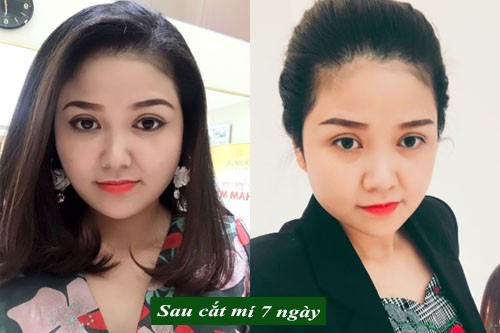 Cần biết - Những chia sẻ về cắt mí mắt của Hồng Nhiên giúp bạn không phải hối hận khi làm đẹp  (Hình 5).