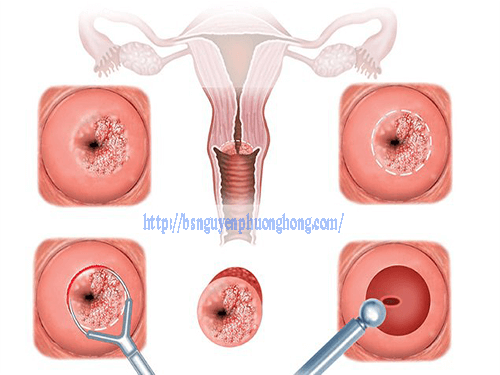 Cần biết - Địa chỉ đốt viêm lộ tuyến cổ tử cung ở đâu hiệu quả và an toàn (Hình 2).