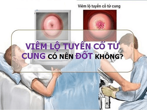 Cần biết - Viêm lộ tuyến cổ tử cung có nên đốt điện không?