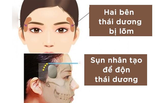 Cần biết - Trẻ hóa gương mặt với phương pháp độn thái dương (Hình 2).