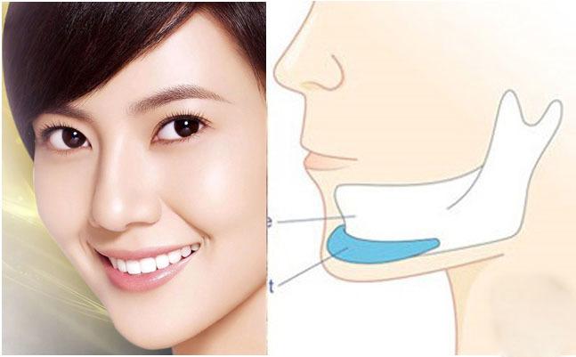 Cần biết - Độn cằm V-line có duy trì trọn đời không? (Hình 2).