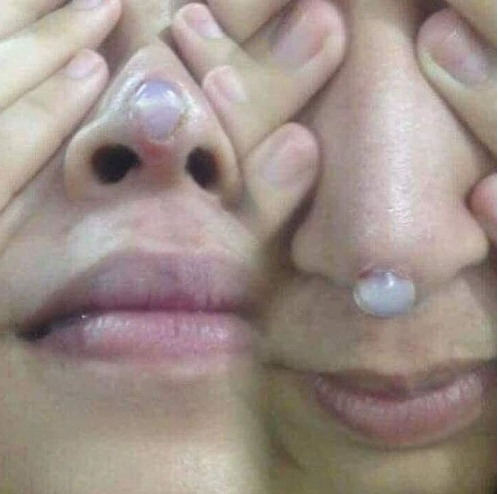 Truyền th&ocirc;ng - N&acirc;ng mũi cấu tr&uacute;c XƯA v&agrave; NAY c&oacute; g&igrave; kh&aacute;c biệt?