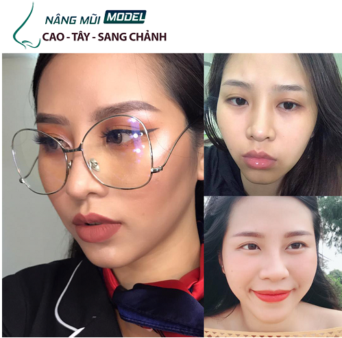 Truyền th&ocirc;ng - N&acirc;ng mũi cấu tr&uacute;c XƯA v&agrave; NAY c&oacute; g&igrave; kh&aacute;c biệt? (H&igrave;nh 2).