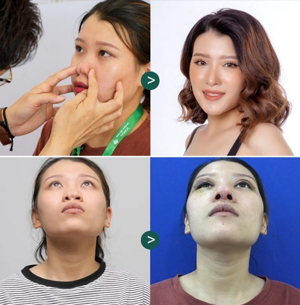 Truyền th&ocirc;ng - N&acirc;ng mũi cấu tr&uacute;c XƯA v&agrave; NAY c&oacute; g&igrave; kh&aacute;c biệt? (H&igrave;nh 3).