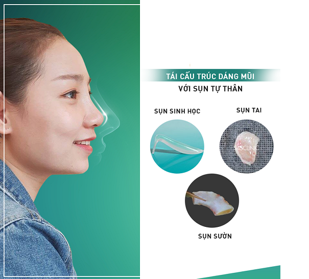 Truyền th&ocirc;ng - N&acirc;ng mũi cấu tr&uacute;c XƯA v&agrave; NAY c&oacute; g&igrave; kh&aacute;c biệt? (H&igrave;nh 4).