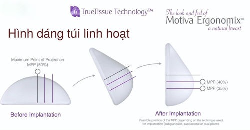 Thương hiệu - Nâng ngực nội soi Nano chip – Giải pháp cho vòng một căng tròn (Hình 3).