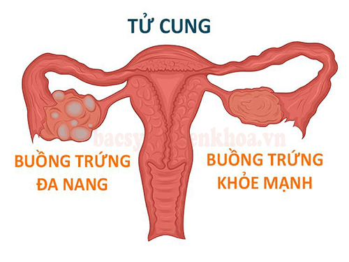 Truyền thông - Hội chứng buồng trứng đa nang và cách điều trị