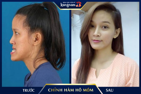 Thương hiệu - Top những ca chỉnh hàm hô móm phức tạp nhất được thực hiện tại Việt Nam (Hình 2).
