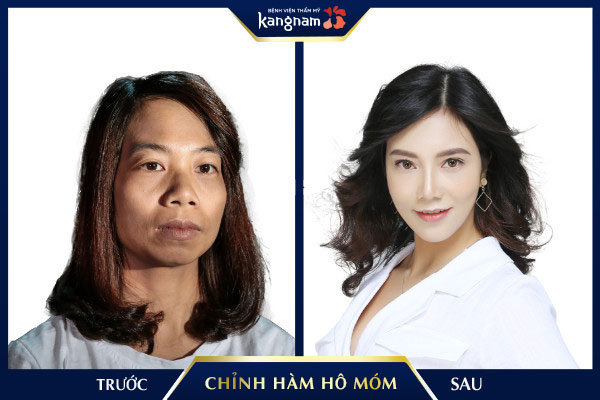 Thương hiệu - Top những ca chỉnh hàm hô móm phức tạp nhất được thực hiện tại Việt Nam (Hình 3).