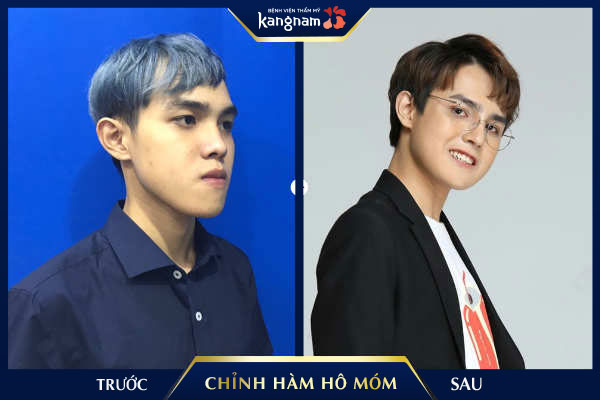Thương hiệu - Top những ca chỉnh hàm hô móm phức tạp nhất được thực hiện tại Việt Nam (Hình 5).