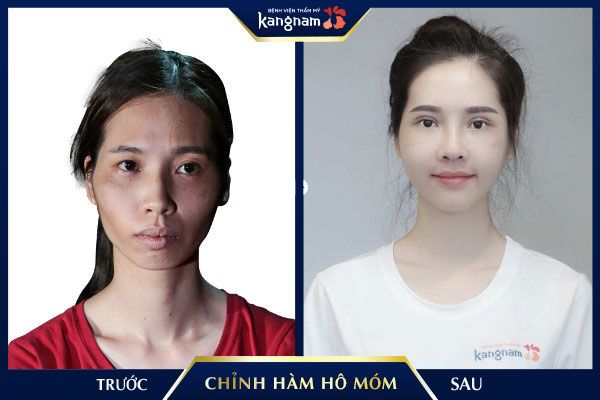 Thương hiệu - Top những ca chỉnh hàm hô móm phức tạp nhất được thực hiện tại Việt Nam (Hình 6).