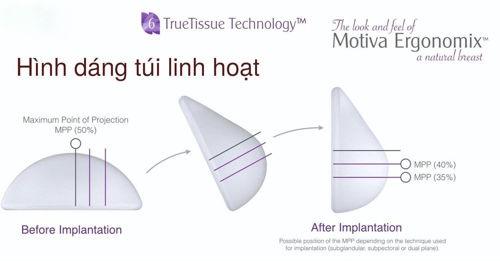 Cần biết - Nâng ngực túi Ergonomic có thật sự an toàn? (Hình 3).