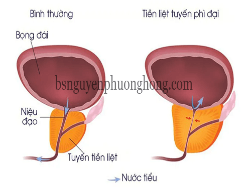 Cần biết - U phì đại tuyến tiền liệt ở nam giới nguy hiểm như thế nào?