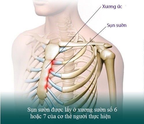 Truyền thông - Nâng mũi sụn tự thân liệu có an toàn tuyệt đối 100%?