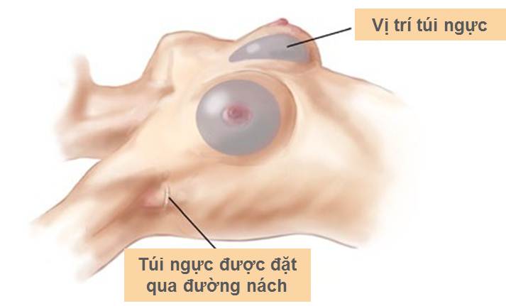 Truyền thông - Nên thực hiện nâng ngực nội soi bằng đường nào là tốt nhất? (Hình 2).