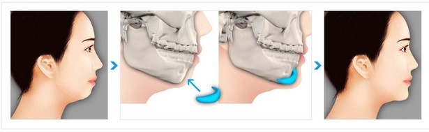 Truyền thông - Những giải pháp nào khắc phục cằm ngắn, cằm lẹm hiệu quả? (Hình 2).