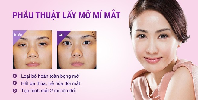 Thương hiệu - Địa chỉ lấy mỡ thừa mí mắt (Hình 2).