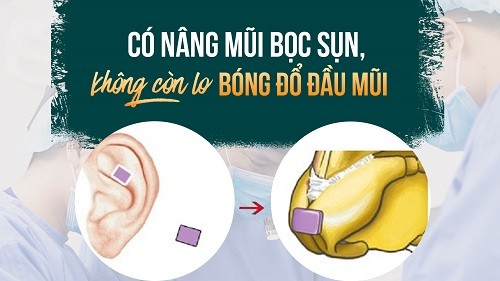 Thương hiệu - Nâng mũi bọc sụn tai - Mũi cao tự nhiên, không lo biến chứng