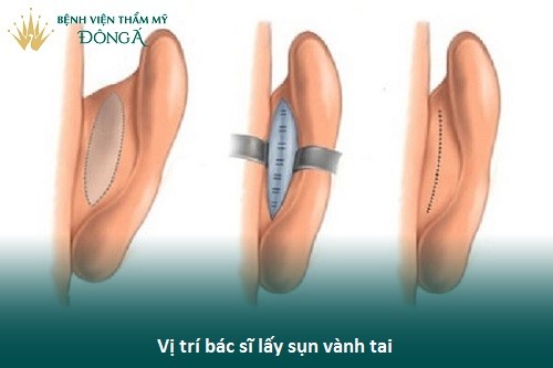 Thương hiệu - Nâng mũi bọc sụn tai - Mũi cao tự nhiên, không lo biến chứng (Hình 3).