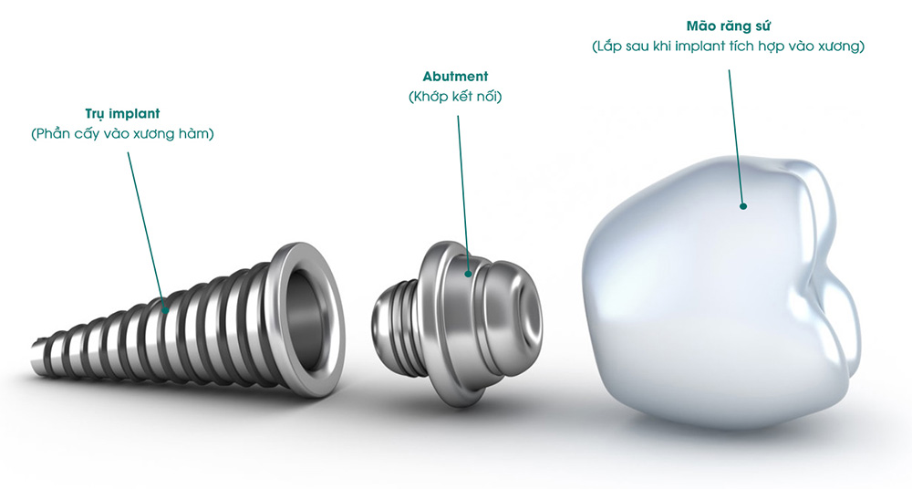 Truyền thông - Cấy ghép implant có đau không, biến chứng khi làm sai quy trình