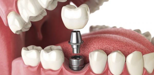 Truyền thông - Cấy ghép implant có đau không, biến chứng khi làm sai quy trình (Hình 2).