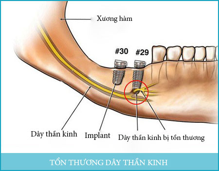 Truyền thông - Cấy ghép implant có đau không, biến chứng khi làm sai quy trình (Hình 3).