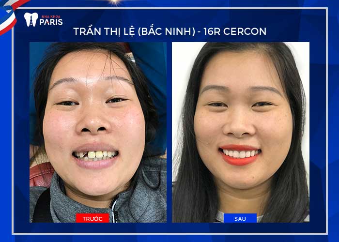 Truyền thông - Cấy ghép implant có đau không, biến chứng khi làm sai quy trình (Hình 5).