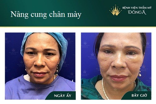 Truyền thông - Nâng cung chân mày - Cho đôi mắt cân đối, chuẩn đẹp tự nhiên (Hình 2).