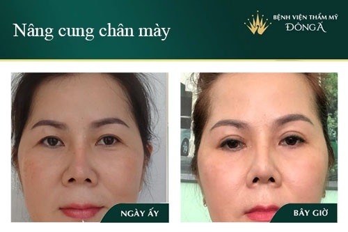 Truyền thông - Nâng cung chân mày - Cho đôi mắt cân đối, chuẩn đẹp tự nhiên (Hình 3).