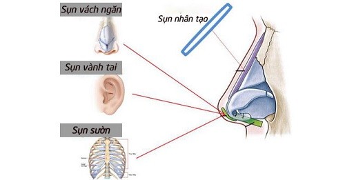 Truyền thông - Nên nâng mũi sụn nhân tạo hay nâng mũi bọc sụn tự thân? (Hình 2).