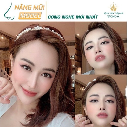 Truyền thông - Nên nâng mũi sụn nhân tạo hay nâng mũi bọc sụn tự thân? (Hình 4).