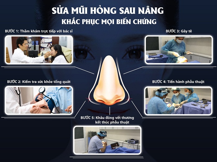 Thương hiệu - Sửa mũi hỏng sau nâng – Khắc phục mọi biến chứng (Hình 3).