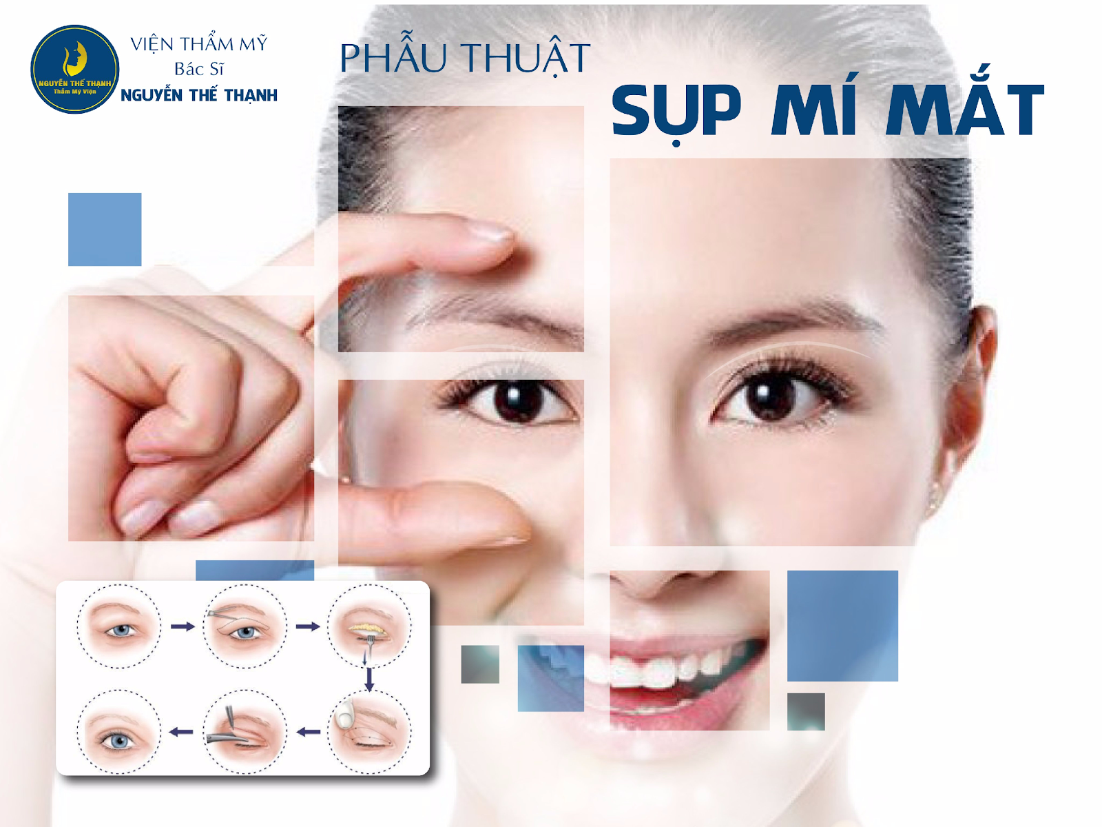 Cần biết - Phẫu thuật sụp mí mắt - Lấy lại đôi mắt hút hồn