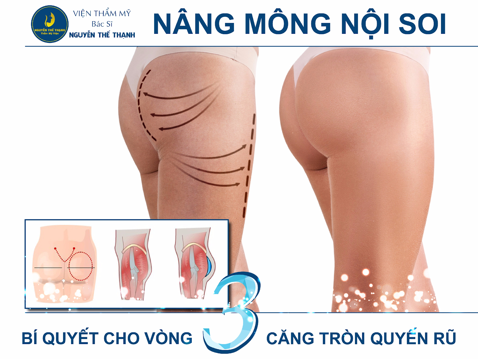 Cần biết - Nâng mông nội soi: Bí quyết cho vòng 3 căng tròn quyến rũ