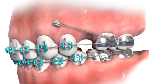 Cần biết - Niềng răng không nhổ răng có được không?