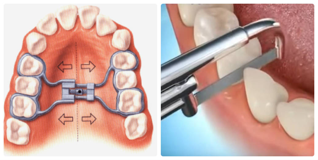 Cần biết - Niềng răng không nhổ răng có được không? (Hình 3).