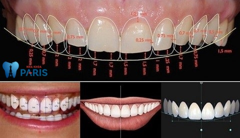 Cần biết - Bọc răng sứ: Cách chữa cười hở lợi an toàn - nhanh chóng - không cần phẫu thuật (Hình 7).