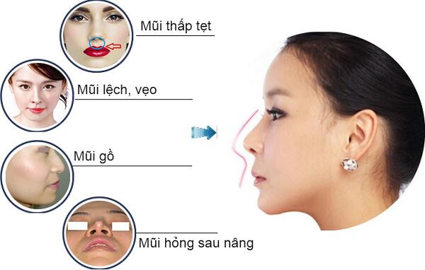 Cần biết - Nâng mũi cấu trúc sụn sườn tự thân là gì? (Hình 2).