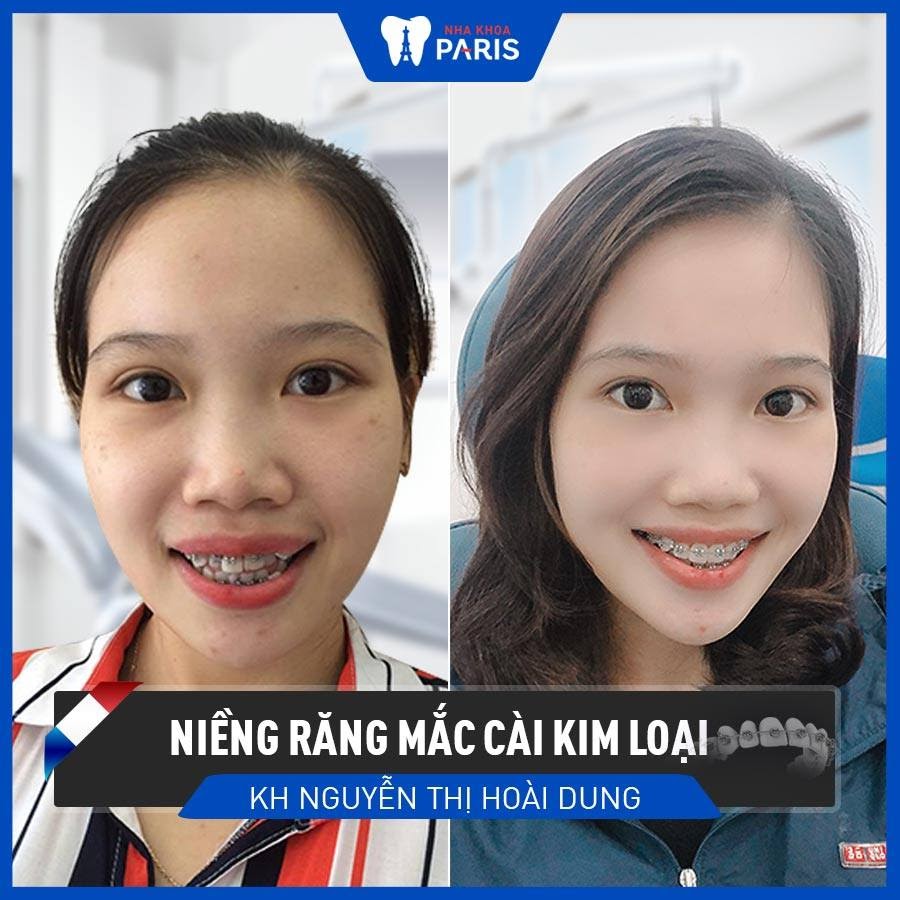 Cần biết - Niềng răng trả góp ở đâu tốt? Niềng răng trả góp chỉ từ 15 triệu đồng (Hình 3).