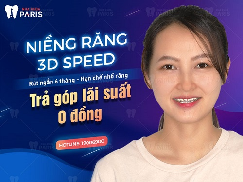 Cần biết - Niềng răng trả góp ở đâu tốt? Niềng răng trả góp chỉ từ 15 triệu đồng (Hình 7).