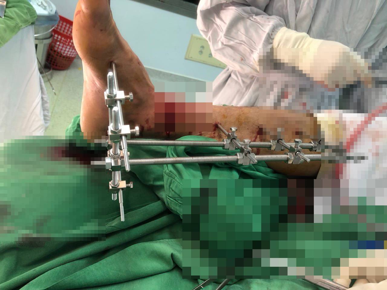 Sức khỏe - Phẫu thuật cứu người đàn ông bị máy cắt cỏ cắt gần lìa bàn chân