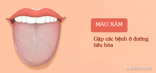 Tư vấn - Màu sắc lưỡi tiết lộ các vấn đề sức khỏe  (Hình 10).